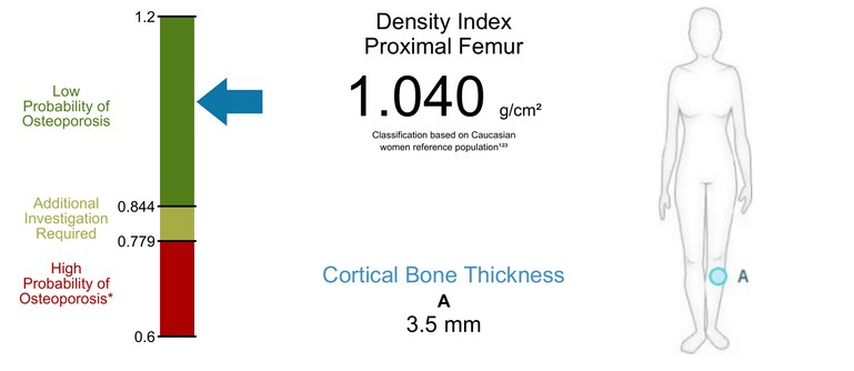 Bindex Ergebnisanzeige mit Dichteindex und kortikaler Knochendicke am Schienbein
